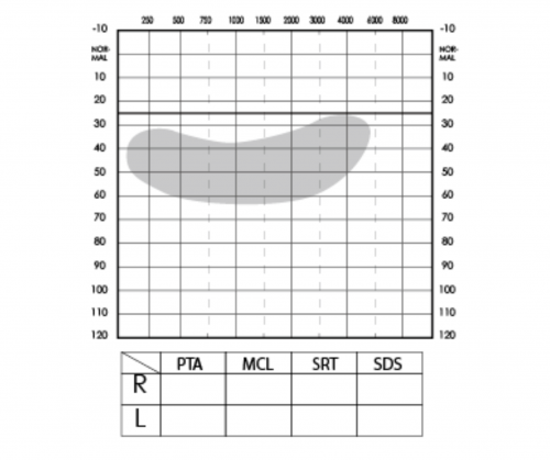 聽力圖 聽力檢測 聽力檢查 聽力損失程度